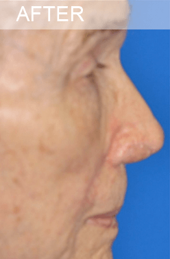 Mohs Surgery Dallas Mohs Surgery Dallas