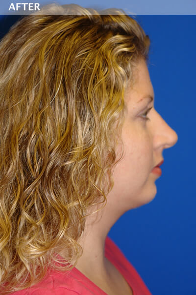 chin surgery dallas