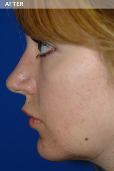 chin surgery dallas
