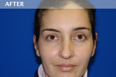ear surgery dallas otoplasty