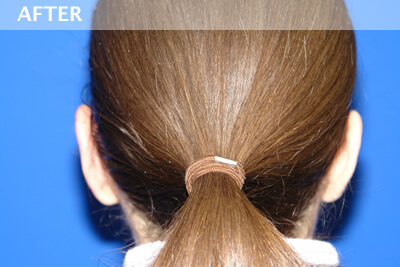 ear surgery dallas otoplasty