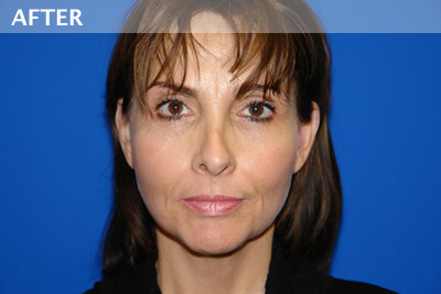 eyelid surgery dallas