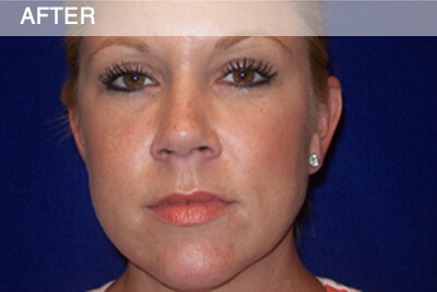 eyelid surgery dallas