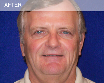 eyelid surgery dallas