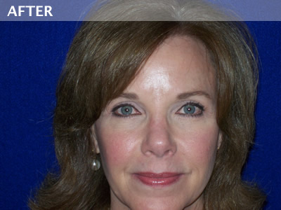 eyelid surgery dallas