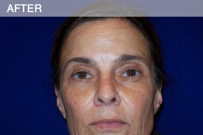 eyelid surgery dallas