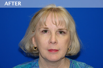 eyelid surgery dallas