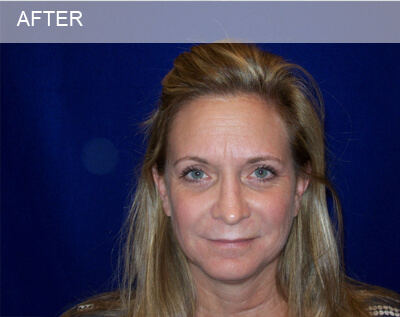 eyelid surgery dallas