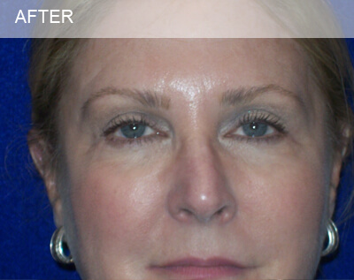 eyelid surgery dallas