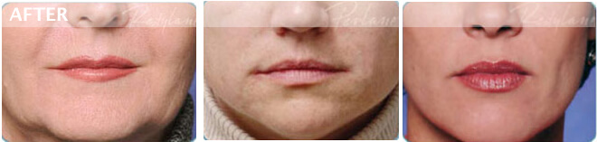 restylane juvederm dallas