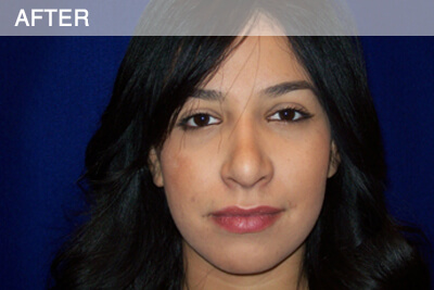 rhinoplasty after photo dallas