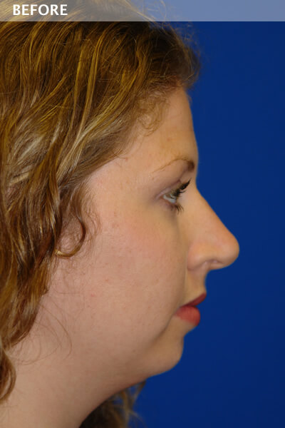 chin surgery dallas