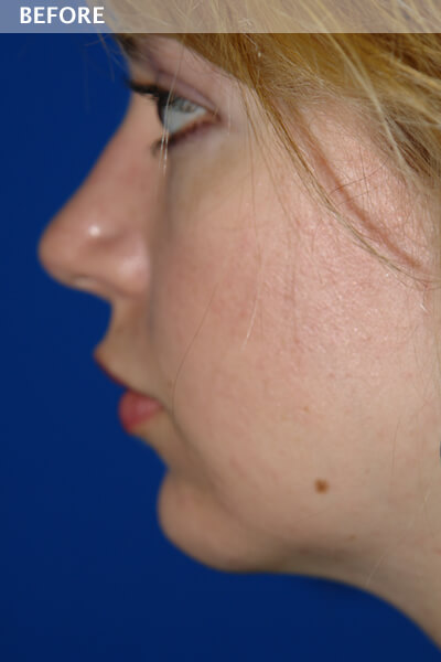 chin surgery dallas