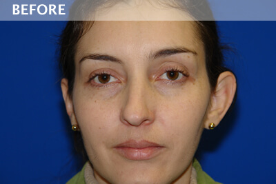 ear surgery dallas otoplasty