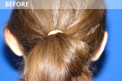 ear surgery dallas otoplasty