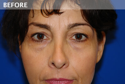eyelid surgery dallas