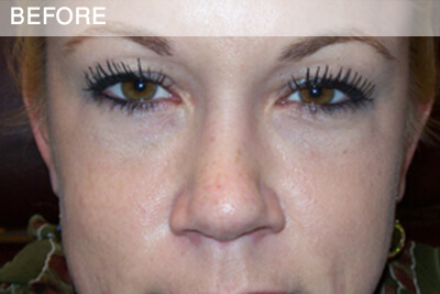 eyelid surgery dallas