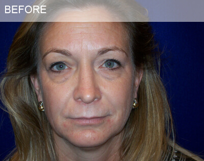 eyelid surgery dallas