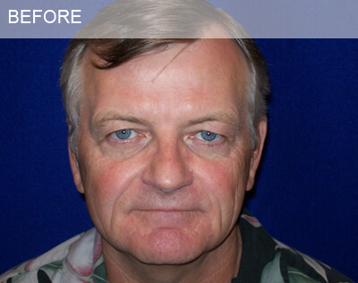 eyelid surgery dallas