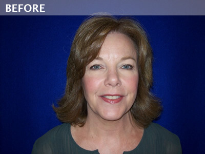 eyelid surgery dallas