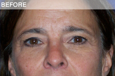 eyelid surgery dallas