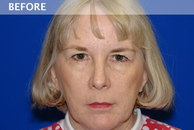 eyelid surgery dallas
