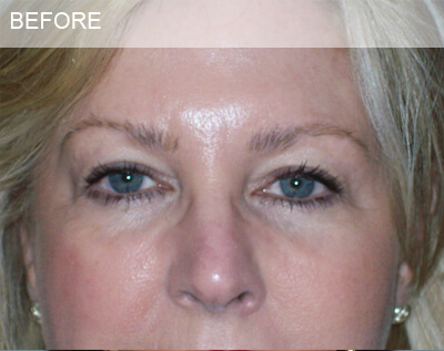 eyelid surgery dallas