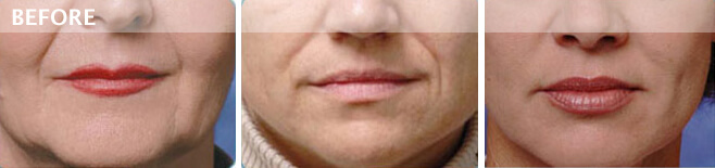 restylane juvederm dallas
