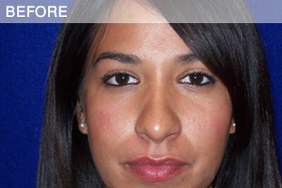 rhinoplasty before photo dallas