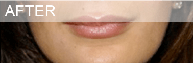 lip_after lip after surgery dallas