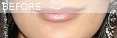 lip_before before lip surgery dallas