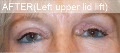liquid lift dallas