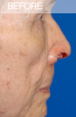 Mohs Surgery Dallas Mohs Surgery Dallas