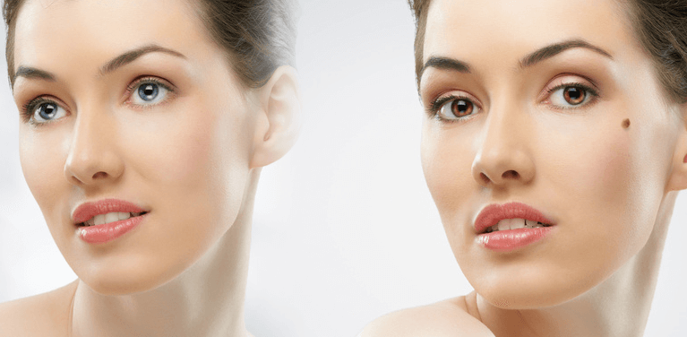 Mole and Small Lesion Removal Dallas Texas