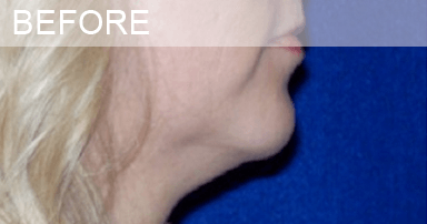 neck_lipo neck liposuction before photo dallas plastic surgeon dr sule