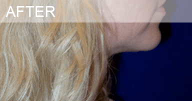 neck_lipo_after neck liposuction after photo dallas texas