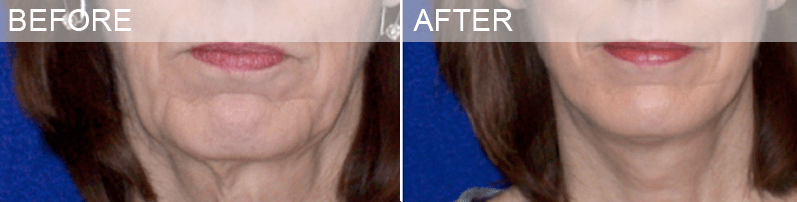 Necklift Dallas necklift dallas surgery