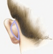 otoplasty incission lines