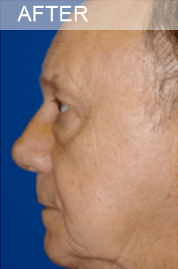 Rhinoplasty Revision Dallas Texas