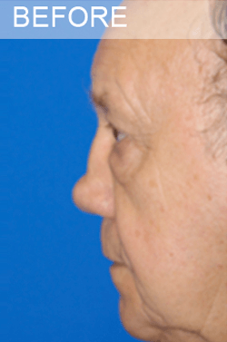 Rhinoplasty Revision Dallas Texas