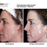 Mini-Peel-example-9-New-side-view