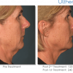 Ultherapy-000L-005Y_0Day-120Day-2TX_BEFORE&AFTER_Full