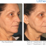 Ultherapy-000L-008Y_0Day-210Day-2TX_BEFORE&AFTER_Full