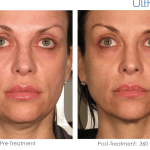 Ultherapy-000P-015Y_0Day-360Day-1TX_BEFORE-&-AFTER_Front-Full