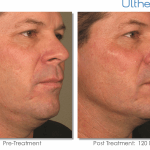 Ultherapy-0058D_0Day-120Day-1TX_BEFORE&AFTER_Full
