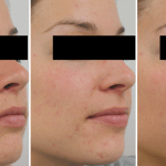 Acne • Baseline, 4 Months, and 10 Months