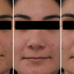 Acne • Baseline, 3 Months, and 6 Months