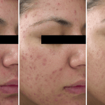 Acne • Baseline, 1 Month, and 5 Months