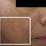 Hyperpigmentation • Baseline, 2 Months, and 5 Months