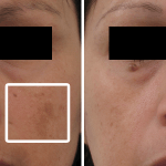 Hyperpigmentation • Baseline and 4 Months